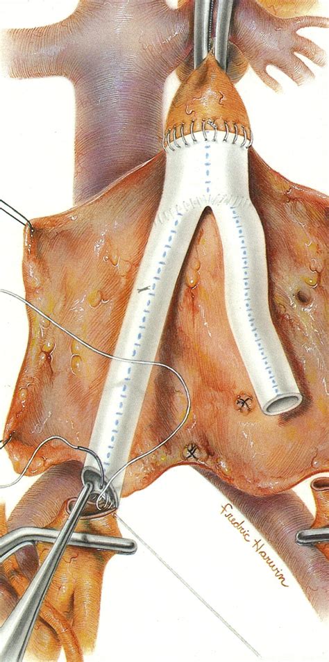The First Gore Tex Femoral Popliteal Bypass Journal Of Vascular Surgery
