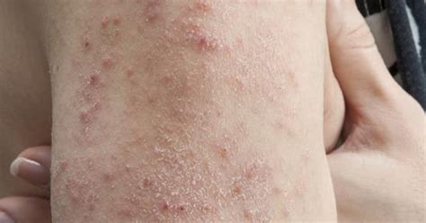 Viral Rashes In Children Causes Symptoms And Prevention Gambaran