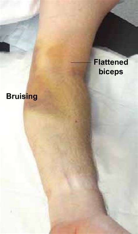 Rupture Of The Distal Biceps Showing Bruising And Change In Muscle