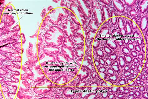 Tubular Adenoma Colon Polyp