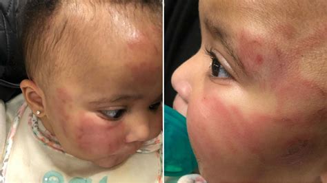 Baby Comes Home Bruised After Falling Down Stairs At Unlicensed Day