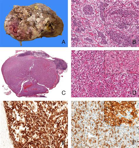 Tfeb Rearranged Renal Cell Carcinoma A Clinicopathologic And Molecular