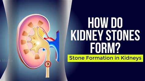How Do Kidney Stones Form Stone Formation In Kidneys Youtube