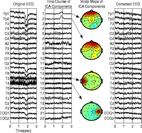 Eeg Artifact Removal With Blind Source Separation