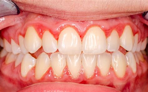 Gingivitis Vs Periodontitis Whats The Difference