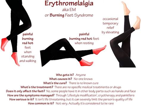 70 Best Images About Erythromelalgia Help On Pinterest Thyroid Test