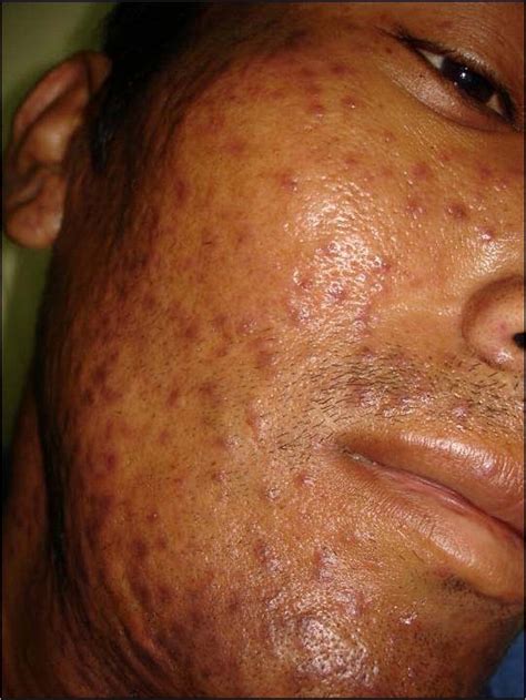 Skin Lesions In Histoplasmosis Clinics In Dermatology