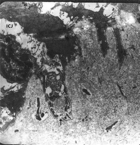 Electron Micrograph Of Homogenous Leukoplakia Shows Discontineous Basal