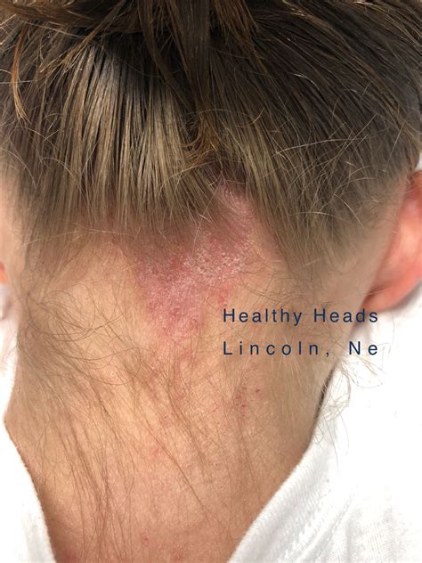 Perfect Example Of A Rash That Can Occur During A Lice Infestation