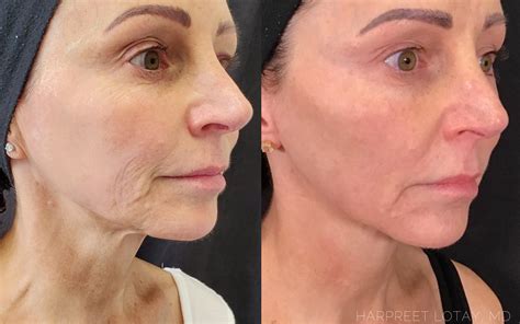 Thebrokensealblog Skin Tightening Morpheus8 Before And After Pictures