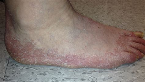 Derm Dx Scaly Rash On The Feet Clinical Advisor