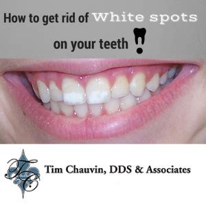 Maybe you would like to learn more about one of these? How to get rid of white spots on your teeth - Dr Chauvin