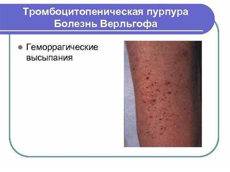 Диета при идиопатической тромбоцитопенической пурпуре ТИПОВЫЕ ФОРМЫ НАРУШЕНИЯ ГЕМОСТАЗА 1. ТРОМБОЗЫ ТИПОВЫЕ ФОРМЫ НАРУШЕНИЯ ГЕМОСТАЗА 1. ТРОМБОЗЫ Диета при идиопатической тромбоцитопенической пурпуре