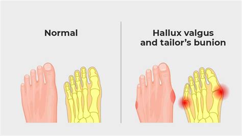 Bunions Causes Symptoms And Treatment What Are Bunions Fitpage