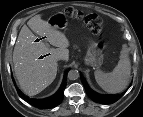 Liver Calcifications And Calcified Liver Masses Pattern Recognition