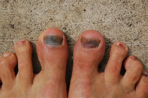 Bruise Under Toenail Pictures Nail Ftempo
