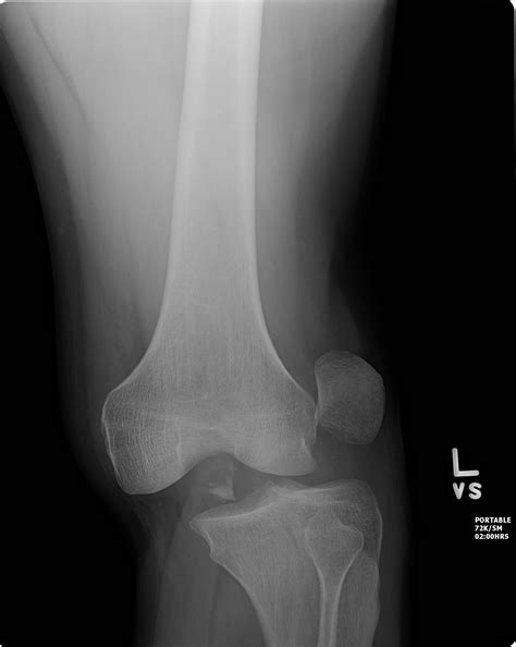 Knee Dislocation Buyxraysonline