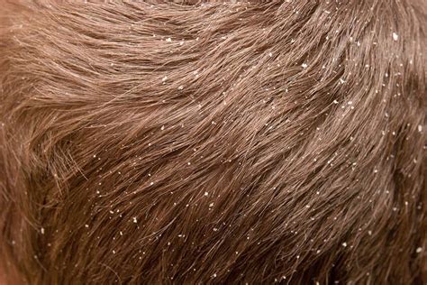 Got Dandruff The Bacteria Living On Your Head Might Be To Blame New