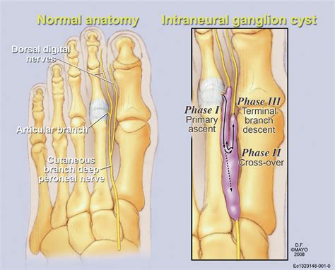 Figure From Peroneal And Tibial Intraneural Ganglion Cysts In The My Xxx Hot Girl