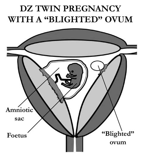 Womb Twin Survivors Signs Of A Twin Conception 6 The Blighted Ovum