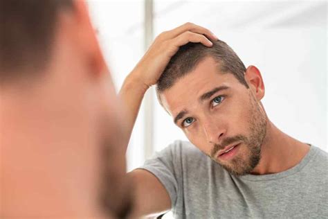 Premature Balding Know Everything That Can Cause It