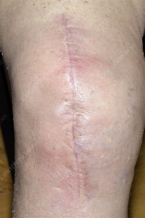 Infected Total Knee Replacement Wound Stock Image C