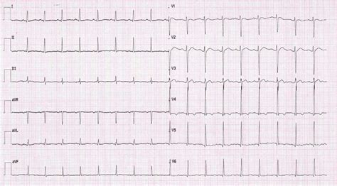 Ecg Electrocardiogram Showing Sinus Tachycardia With T Wave Inversion Download Scientific