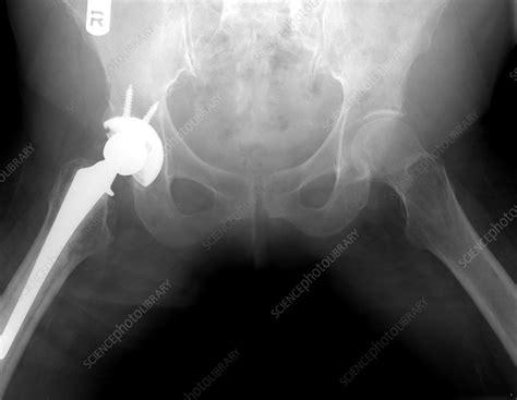 Pelvic Xray Of Total Hip Replacement Stock Image C0124100