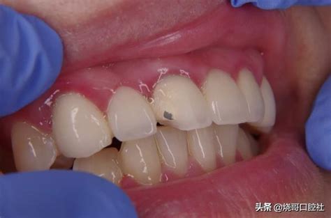 根管後戴牙套牙齦會發黑？醫生：不要選這種牙冠，遠離4個危害 每日頭條