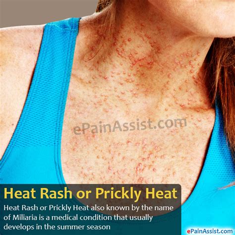 Heat Rash Or Prickly Heat Treatment Home Remedies Prevention Symptoms