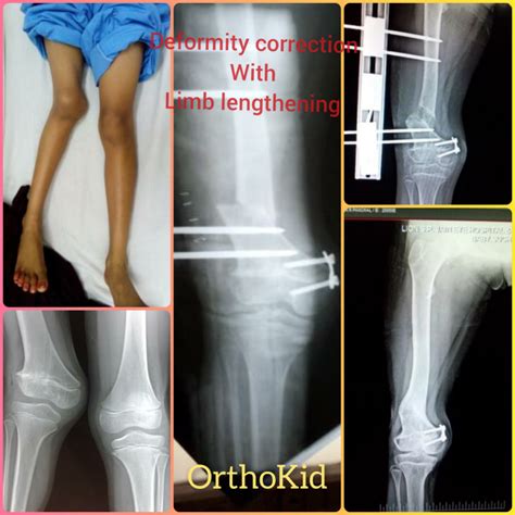 Knee Deformity Genu Valgum With Shortening Of Right Lower Limb Due To