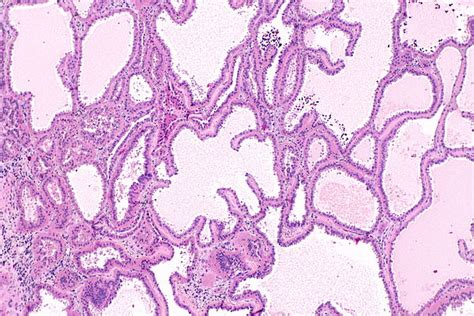 Tubulocystic Carcinoma Of The Kidney Libre Pathology