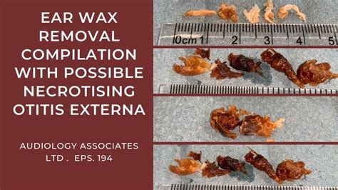 Ear Wax Removal Compilation With Possible Necrotising Otitis Externa