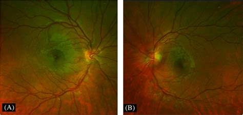 Color Fundus Photographs Crowded Optic Disk In The Right Eye And A