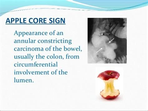 Apple Core Sign Carcinoma Colon Human Anatomy And Physiology