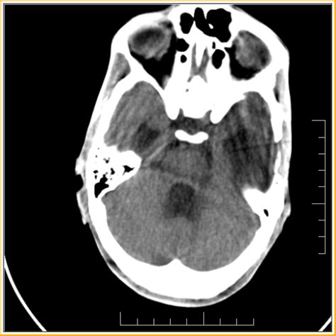 Post Traumatic Hydrocephalus Ct Sumers Radiology Blog