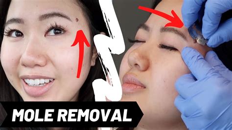The Good The Bad And Mole Removal
