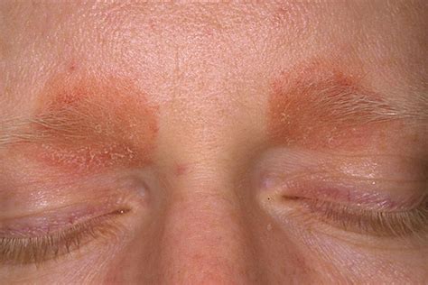 1 Periorbital Disease Optometry Ocular Disease I With Variable At
