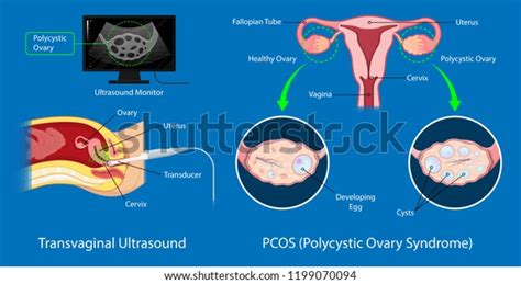 Polycystic Ovary Syndrome Pcos Hormonal Diagnose Stock Vector Royalty Free