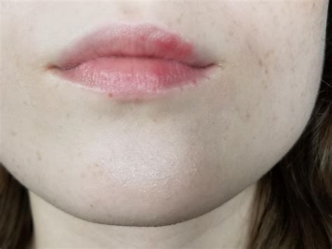 Help Bumpy Textured Red Patches On Upper Lip Skin Concerns