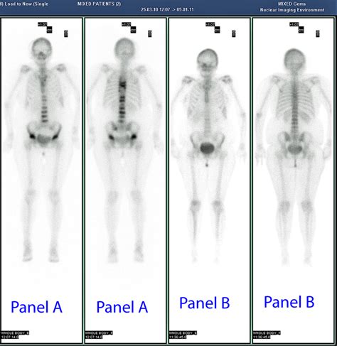 Whole Body 99m Tc Mdp Bone Scintigraphy Panel A Anterior And