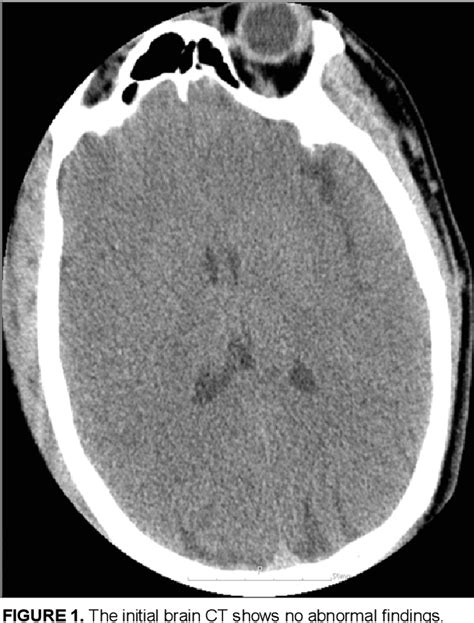 Figure 1 From Post Traumatic Middle Cerebral Artery Dissection