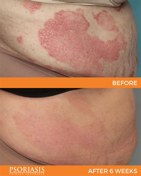 Psoriasis Before And After Treatment Psoriasis Clinics Australia