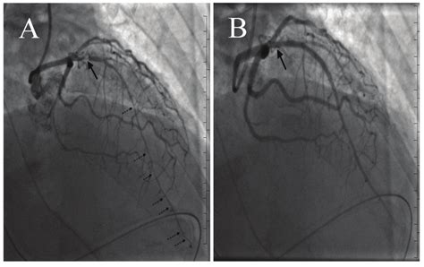 A Coronary Angiography Revealing 95 Stenosis Of Proximal Lad Solid