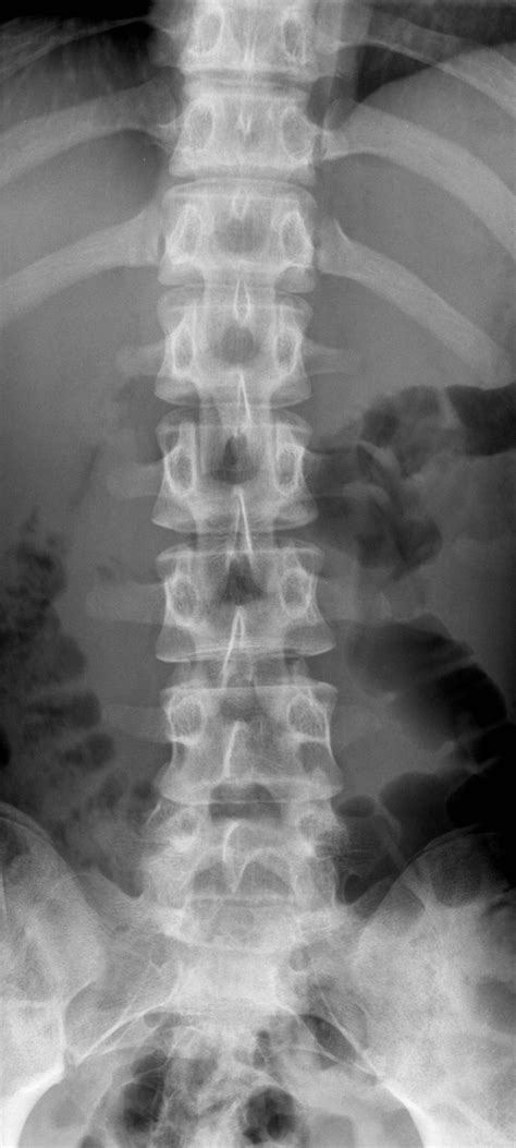 Lumbar Spine Radiographic Anatomy My XXX Hot Girl