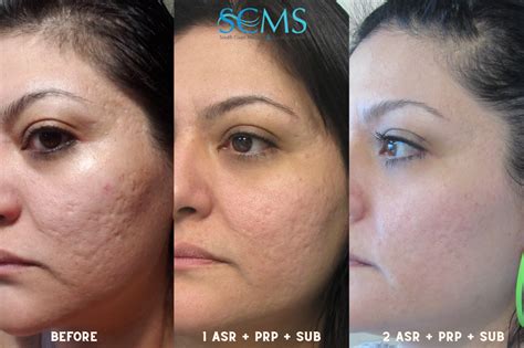 Acne Scar Removal Before And After With Prp And Subcision Laser Acne Scar Removal Laser