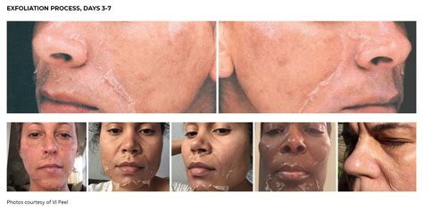 Chemical Peel Peraza Dermatology Group