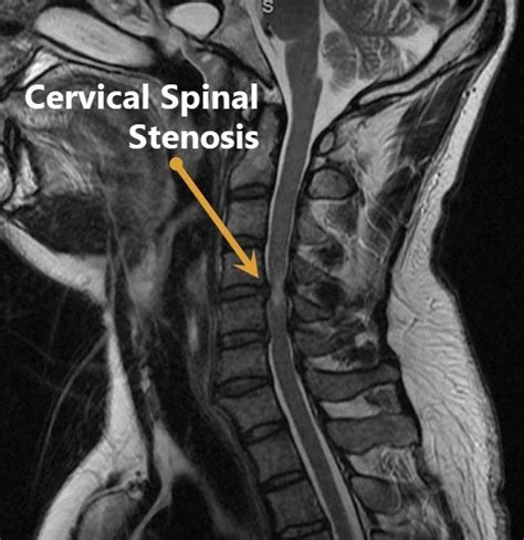 Cervical Stenosis