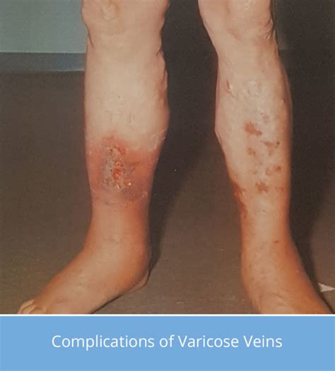 Varicose Vein Types Liverpool Varicose Veins Clinic
