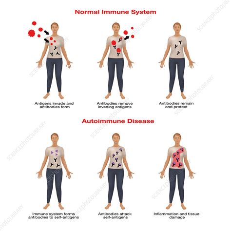 Autoimmune Disease Illustration Stock Image F0317417 Science